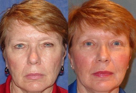 patient before and after