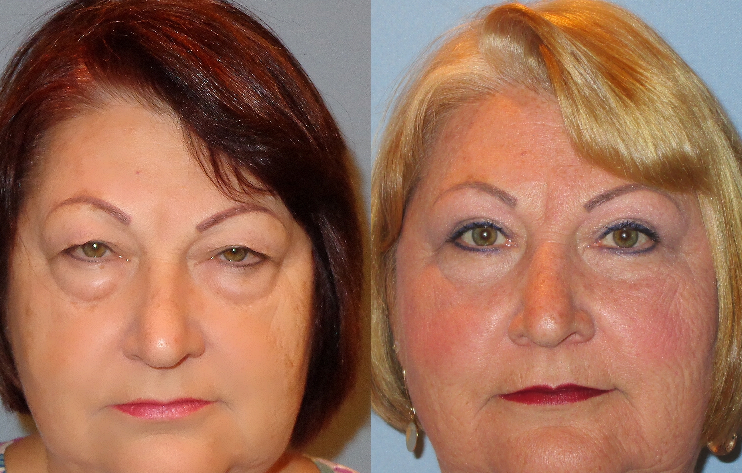 Before and after lower eyelid surgery