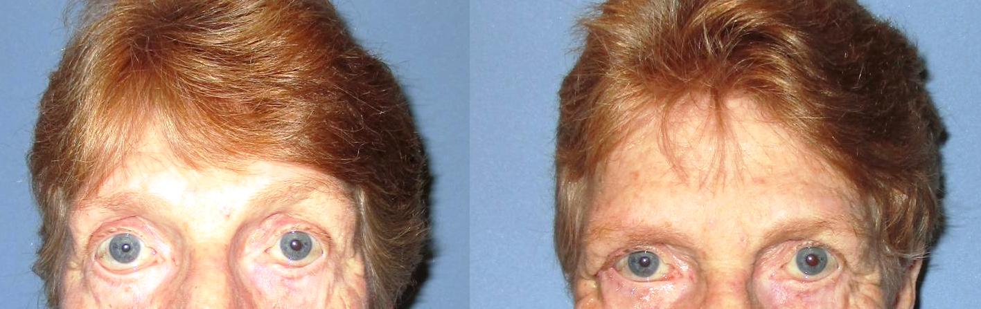 Before and after ectropion procedure