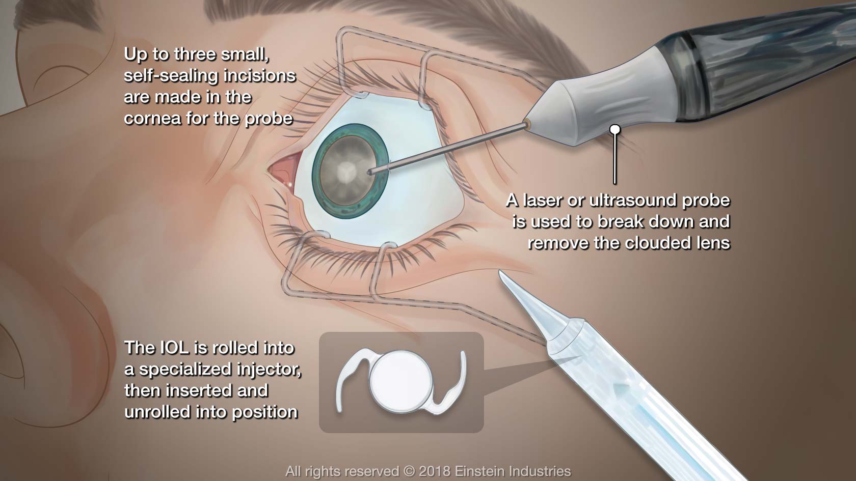 Cataract surgery illustration