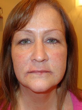 Restylane Lyft After Photo