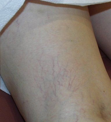 Spider veins after photo