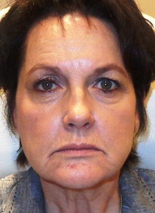 Radiesse Before Photo