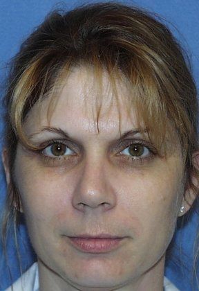 Obagi Blue Peel Before Photo