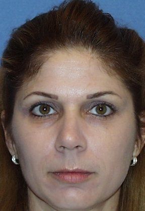 Obagi Blue Peel After Photo