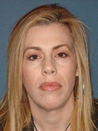 Dysport Before Photo